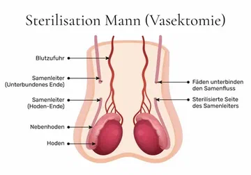 Vasectomy Auckland: What to Expect Before, During, and After the Procedure